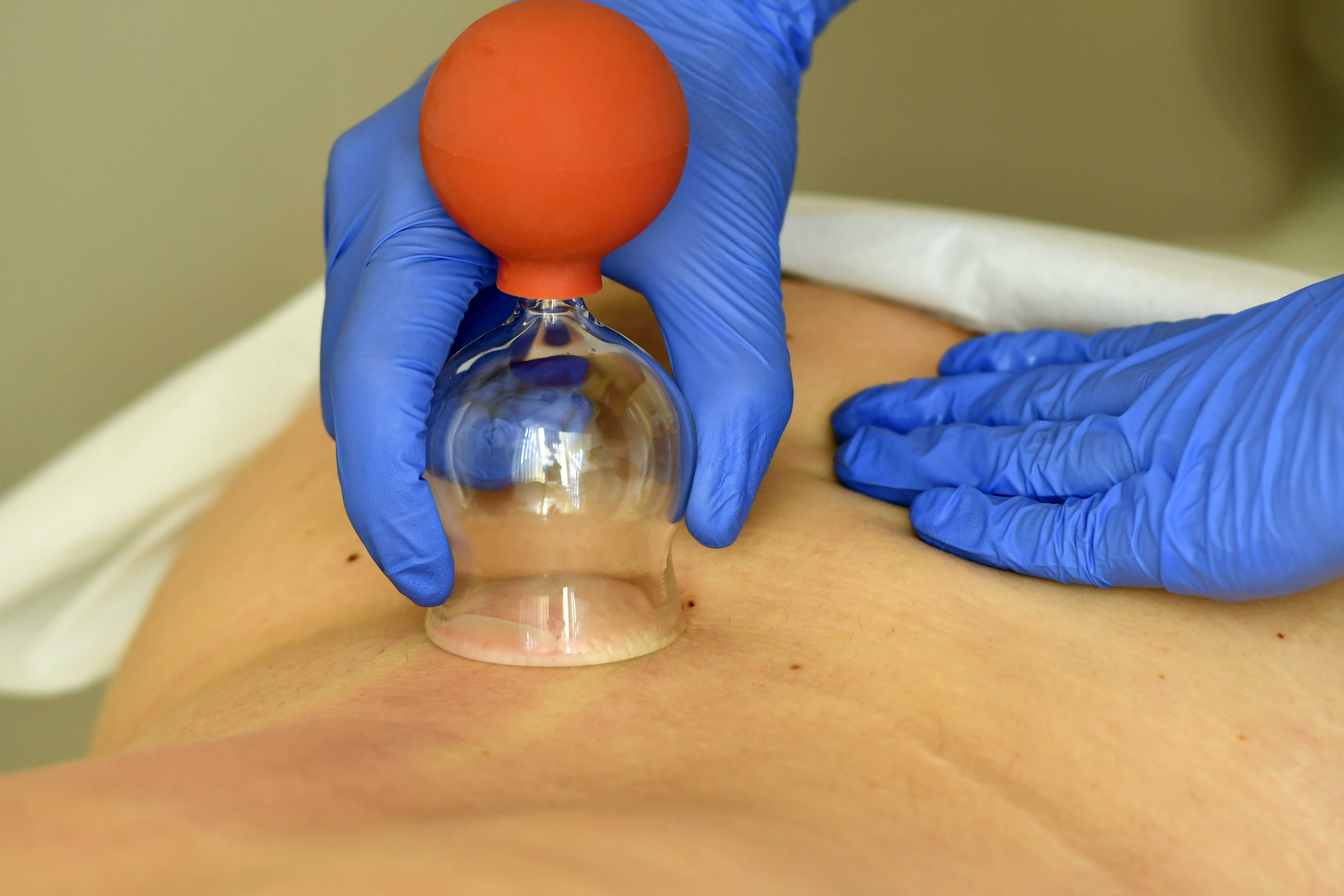 Behandlungssituation in der Naturheilpraxis Meiningen – Schröpftherapie
